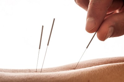 needling